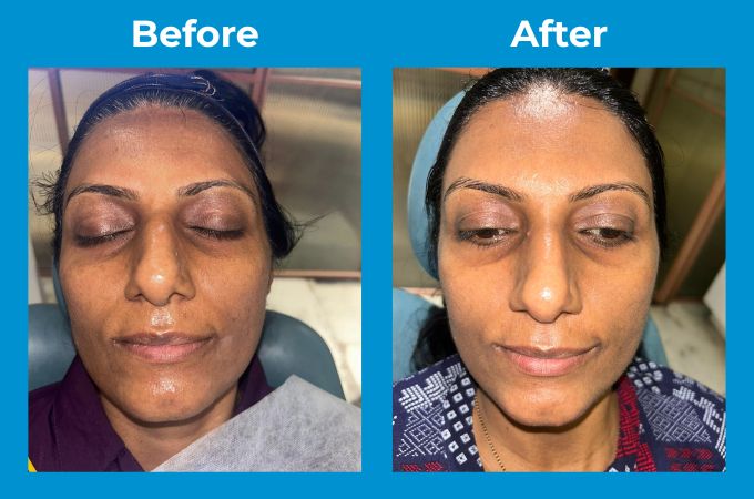 Skin Laser & Hydrafacial