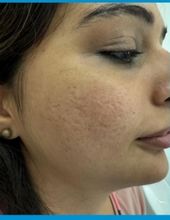 Acne scars — before treatment
