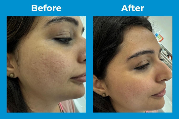 Acne Scars