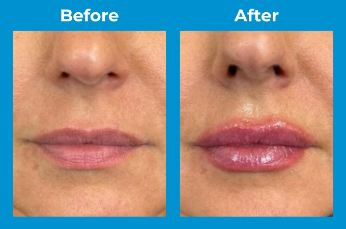 Lip Plumping