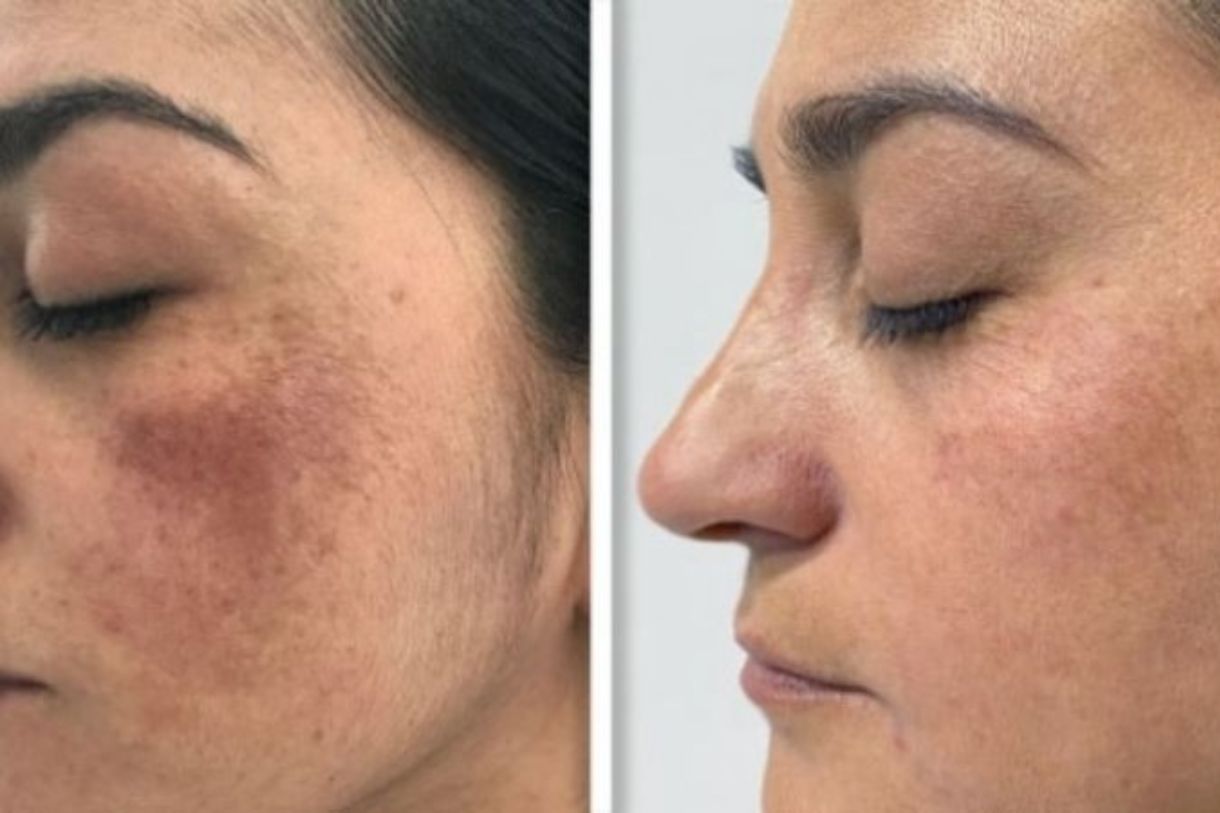 Pigmentation & Uneven Tone