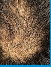 GFC PRP hair restoration — before treatment