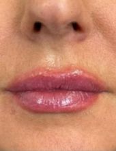 Lip plumping — after treatment at Ogha Health