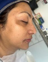 Skin pigmentation correction — after treatment at Ogha Health