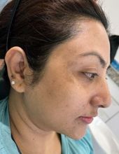 Skin pigmentation — before treatment