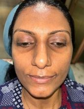 Skin laser and HydraFacial — after treatment at Ogha Health Gachibowli