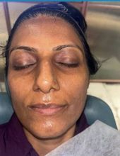 Skin laser and HydraFacial — before treatment