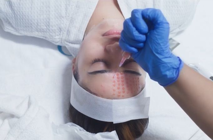 Chemical Peels